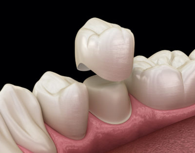 A rendering of a dental crown being placed over a tooth