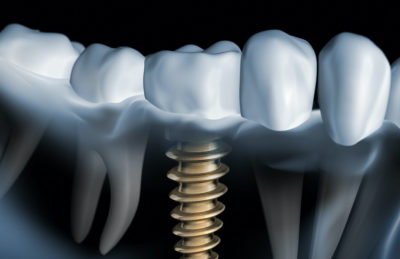 A rendering of a dental implant: an object like a screw replaces the root of a tooth.
