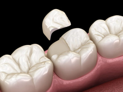 A rendering of a tooth receiving an onlay procedure.