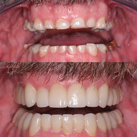 Two images of a man's teeth. In the top, the teeth are small and gums are excessively large, in the bottom they are straight and white and full-sized.