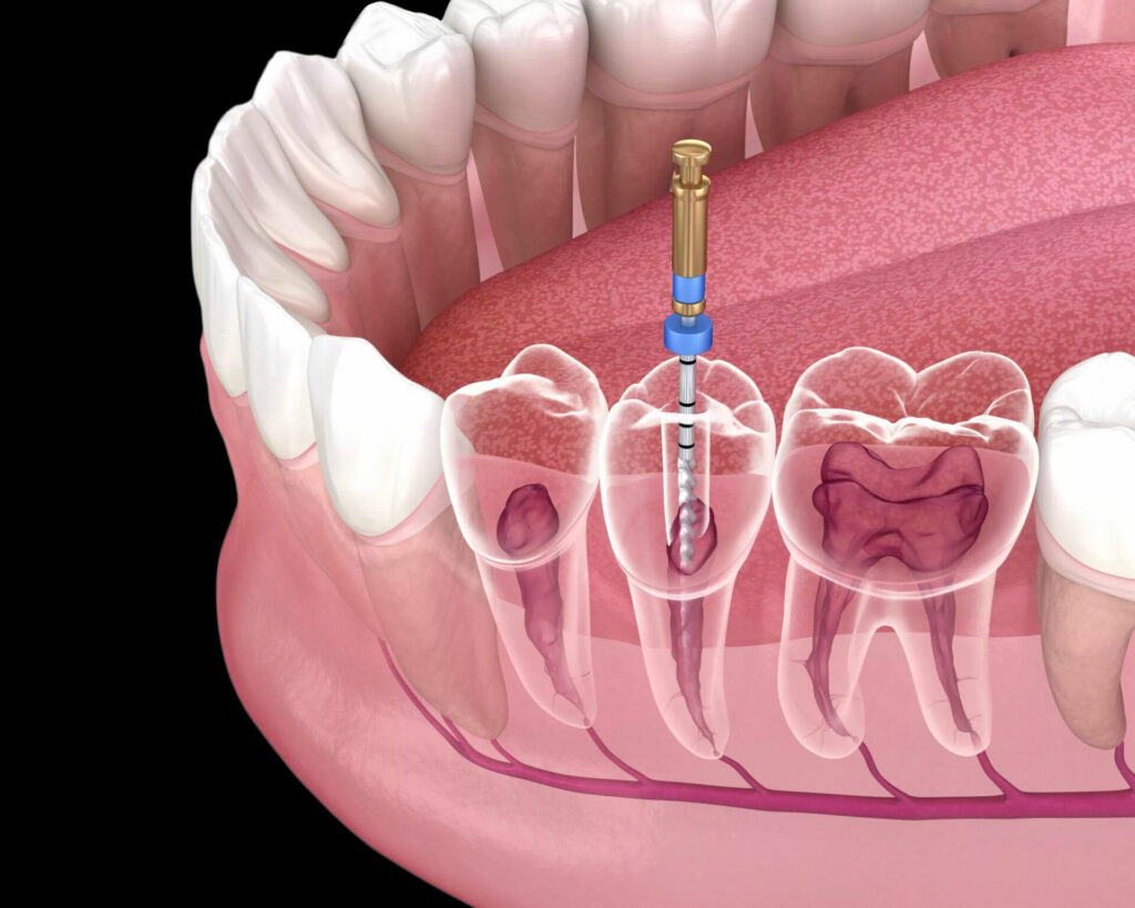 Root Canal Therapy in Calgary