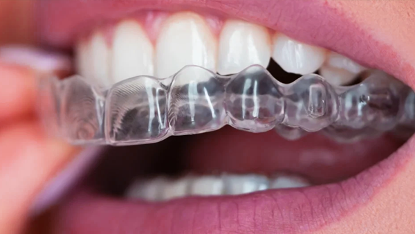 Invisalign in Calgary