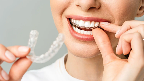 Custom Mouthguards in Calgary