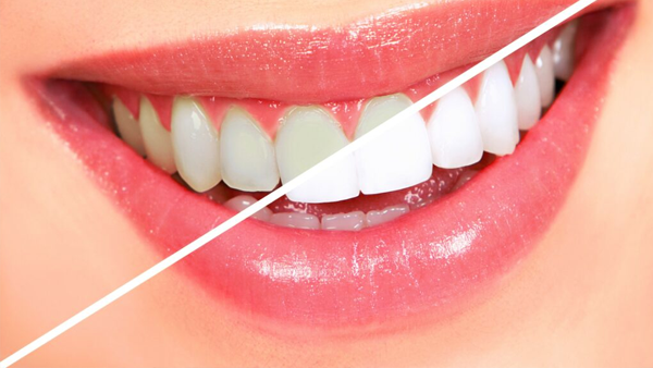 Teeth Whitening in Calgary